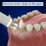 Ultrasonic tip lifting tartar along the gumline